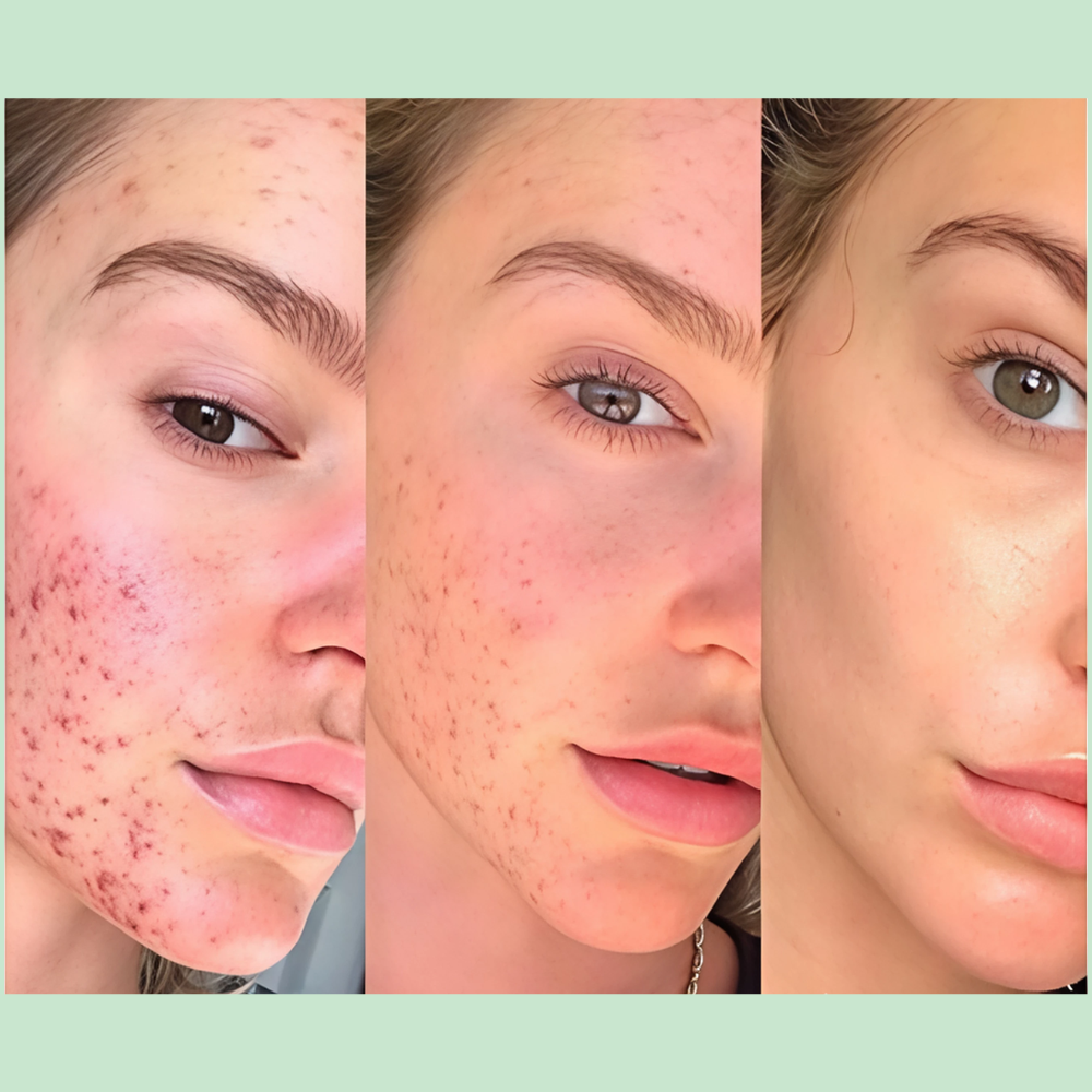 Luméa Radiance Wand-Neon + Argon (6 Pieces - 60% OFF)