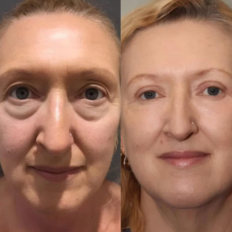 ReviveLux Red - Light Therapy Glasses